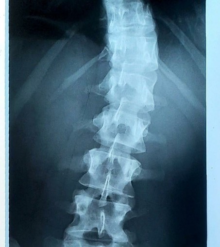 Radiographie de colonne vertébrale, scoliose.
